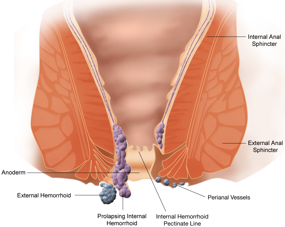 Schema anatomico del retto e dell'ano con le emorroidi interne ed esterne